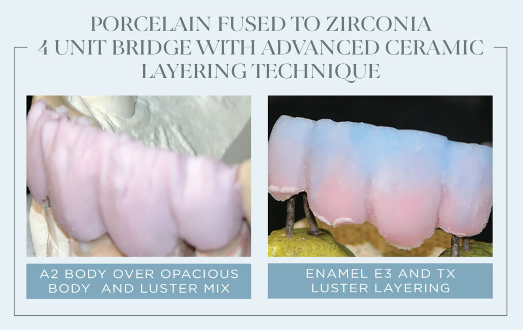 Porcelain Fused to zirconia 4 unit bridge with advanced ceramic layering technique