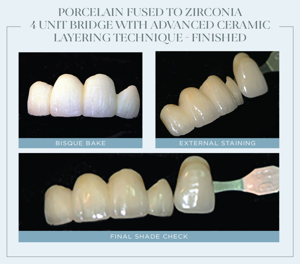 Porcelain Fused to zirconia 4 unit bridge with advanced ceramic layering technique - Finished