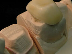 COPING-WITH-SHADE-BASED-STAIN-APPLIED-Build-up-2