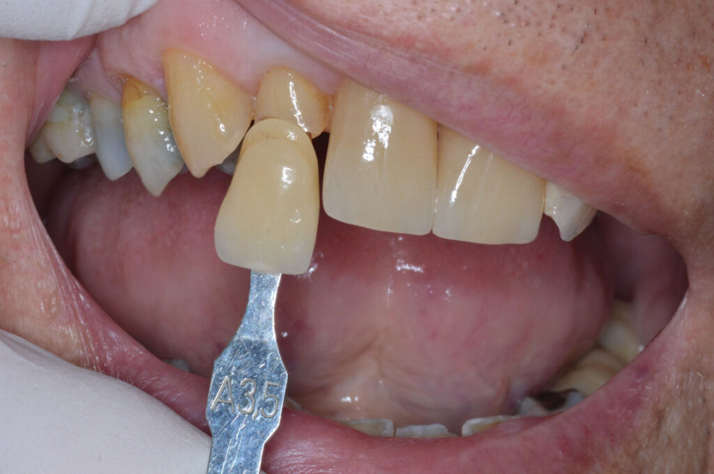 EMAX-CROWN-#7---Crown-going-on-old-tooth