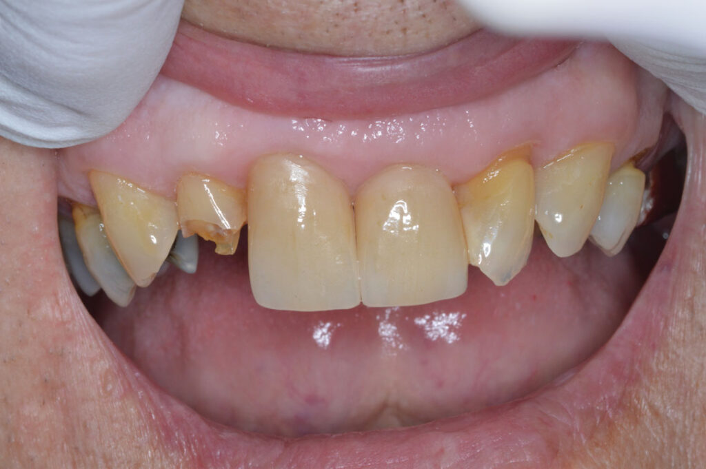 EMAX-CROWN-#7---Showing-broken-tooth