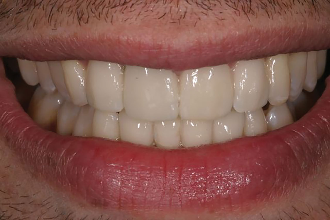 EMAX-FULL-VENEER-CASEUPPER-#6---12-&-LOWER-#22---27---After