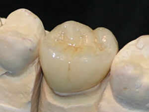 FINISHED-CROWN-IN-LAB-Build-up-4