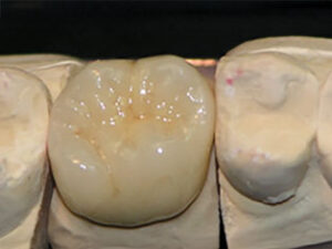 FINISHED-CROWN-IN-LAB-Build-up-5