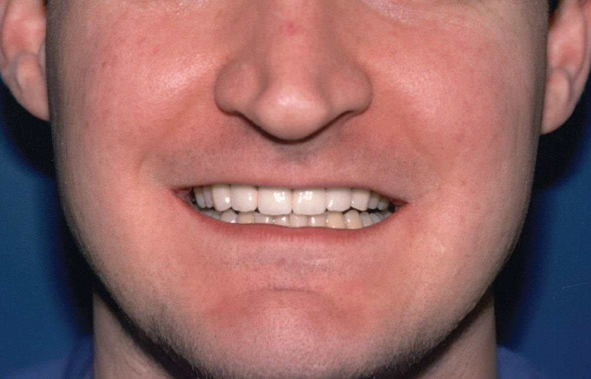 PORCELAIN INFUSED TO METAL, SIX UNIT BRIDGE #6 - 11 - After