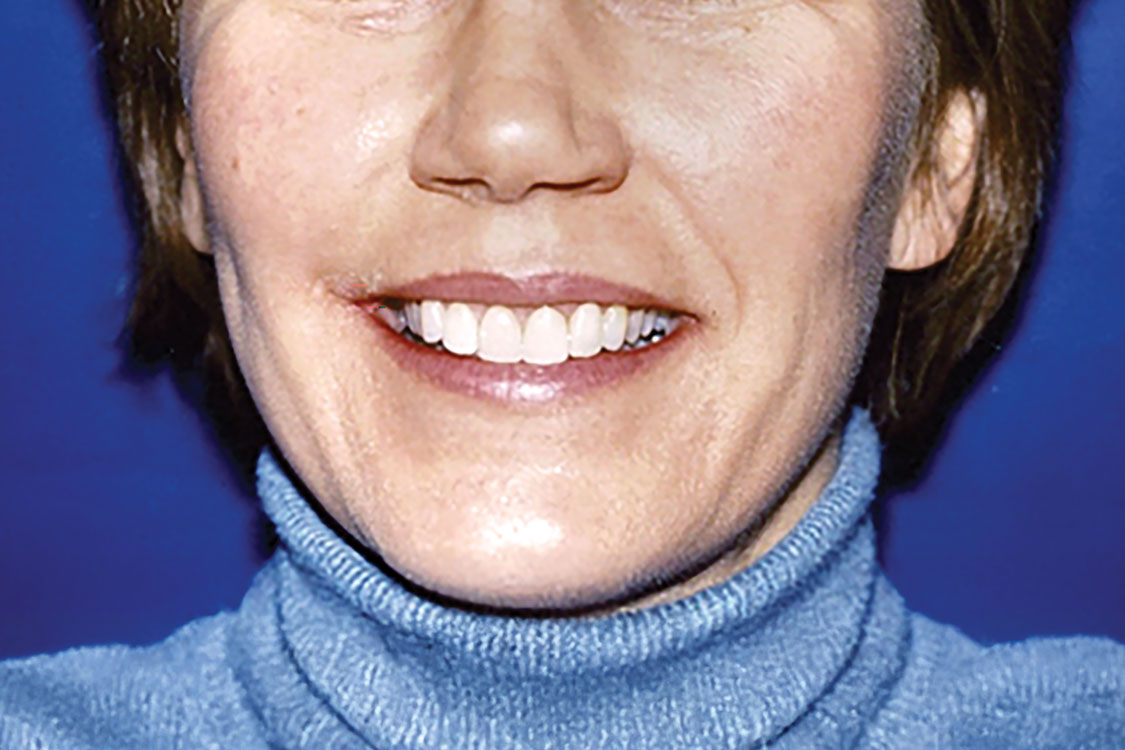 VENEER SMILE ENHANCEMENT CASE #7 - 10 - After