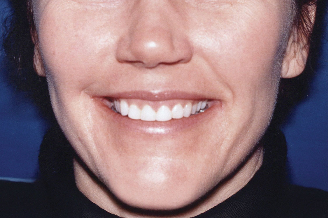 VENEER SMILE ENHANCEMENT CASE #7 - 10 - Before