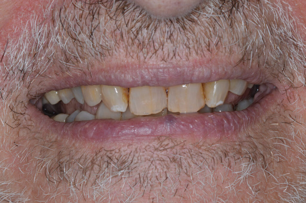 SCREW-RETAINER-PFM-IMPLANT-CROWN-#6-&-#4---After-Crown