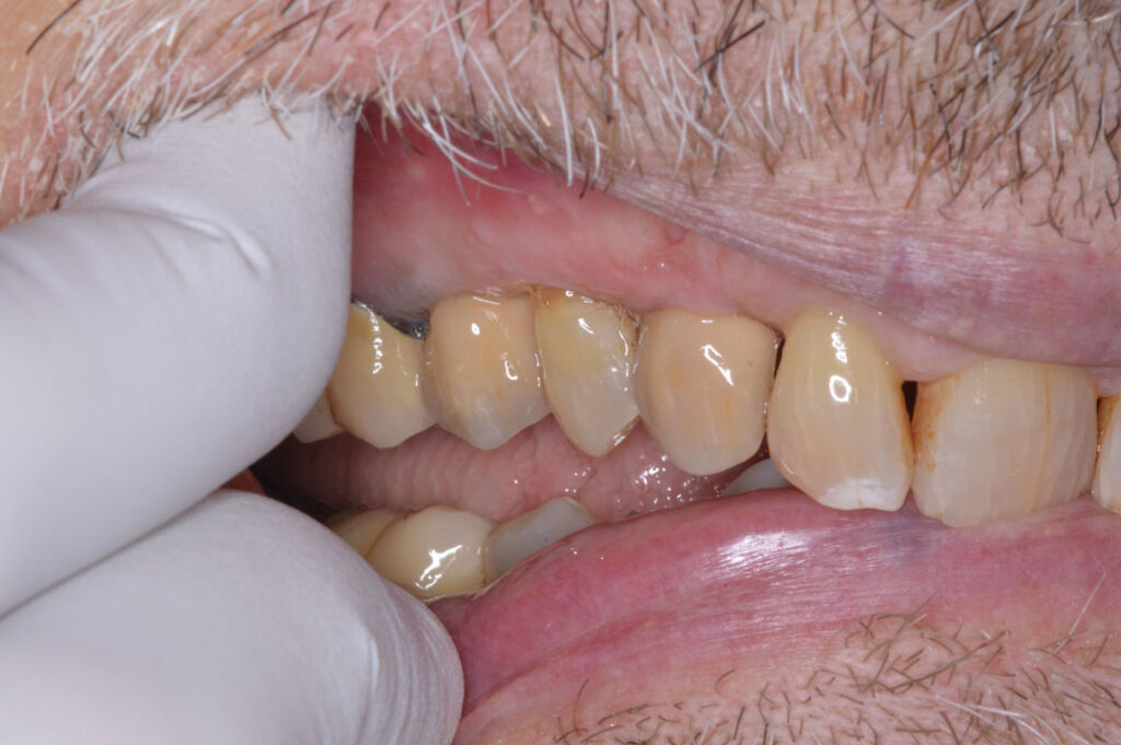 SCREW-RETAINER-PFM-IMPLANT-CROWN-#6-&-#4---Final-Restoration