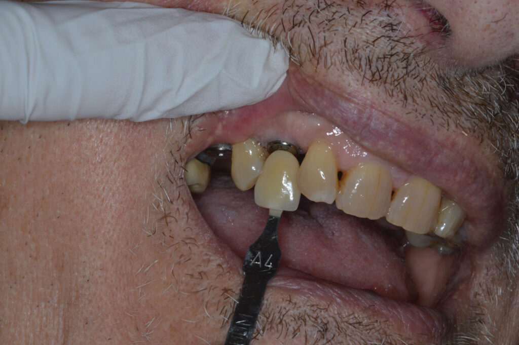 SCREW-RETAINER-PFM-IMPLANT-CROWN-#6-&-#4---Setting-crown