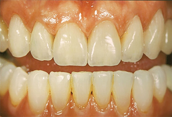 PORCELAIN TO ZIRCONIA VENEER & PORCELAIN JACKET COMBINATION #6 - 12 - After