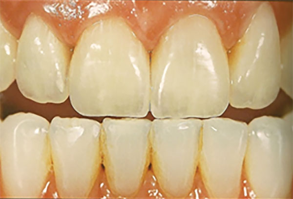 PORCELAIN TO ZIRCONIA VENEER & PORCELAIN JACKET COMBINATION #6 - 12 - veneers 2