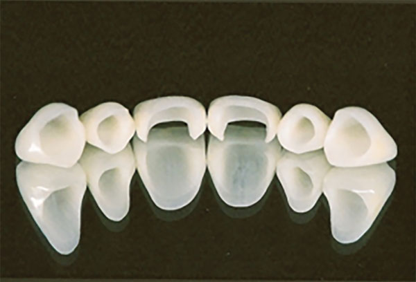 PORCELAIN TO ZIRCONIA VENEER & PORCELAIN JACKET COMBINATION #6 - 12 - veneers