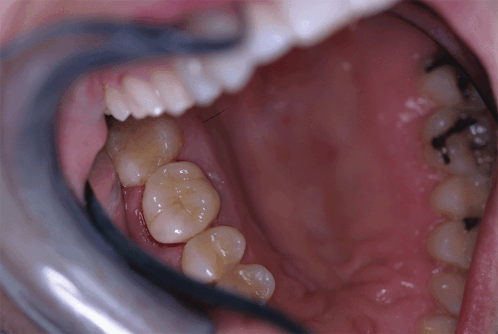 Completed Single Unit Build-Up